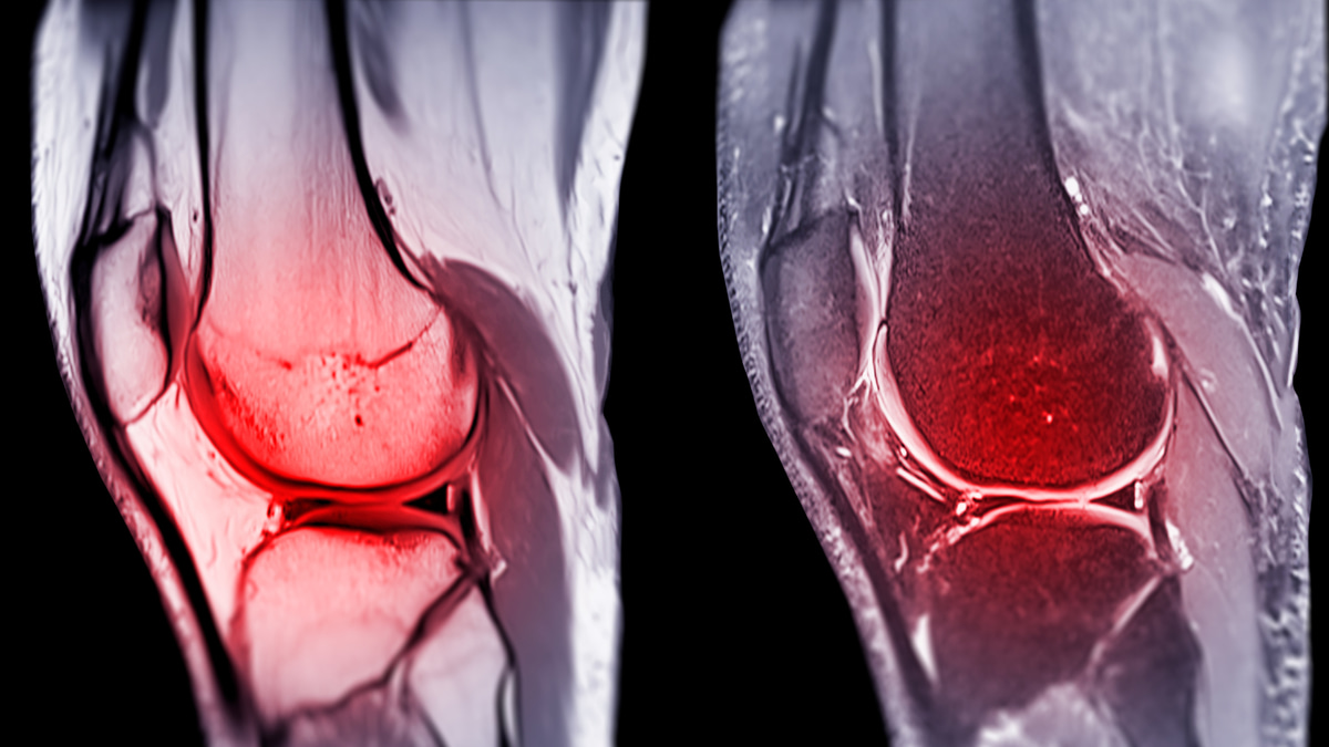 ACL injury