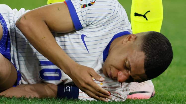 Kylian Mbappe broke his nose against Austria